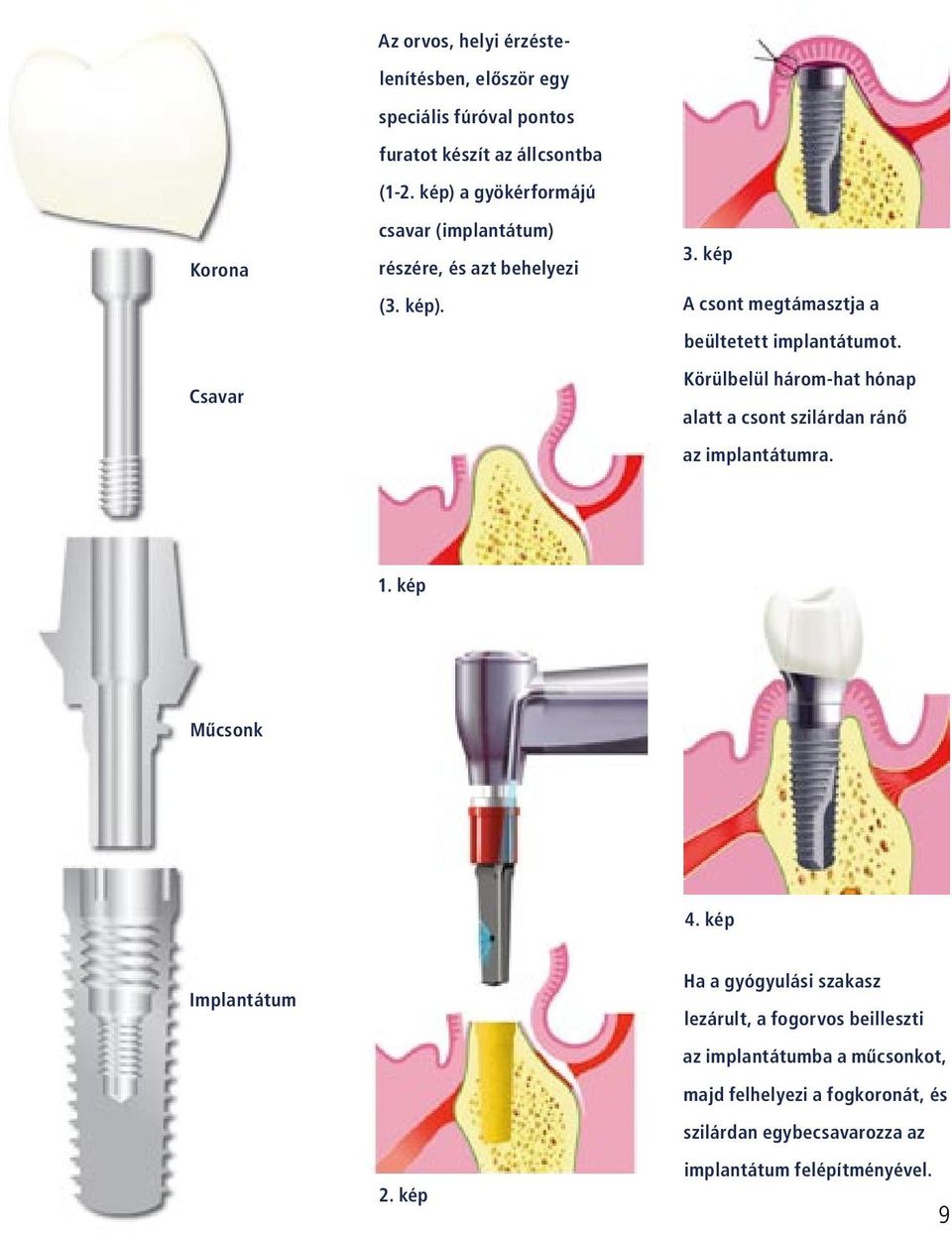 Körülbelül három-hat hónap alatt a csont szilárdan ránô az implantátumra. 1. kép Mûcsonk 4. kép Implantátum 2.
