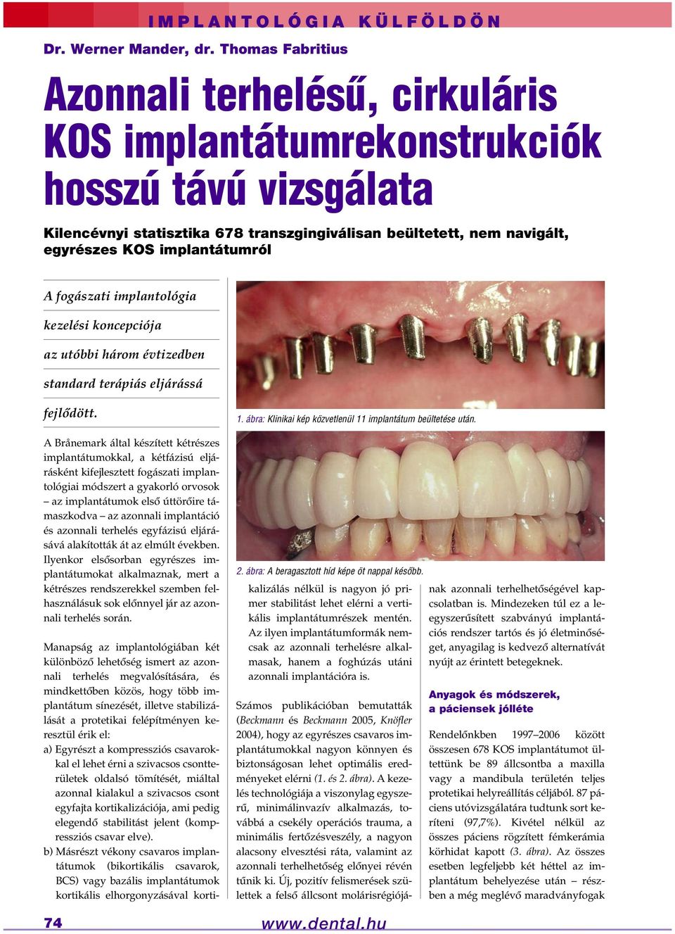 implantátumról A fogászati implantológia kezelési koncepciója az utóbbi három évtizedben standard terápiás eljárássá fejlôdött.