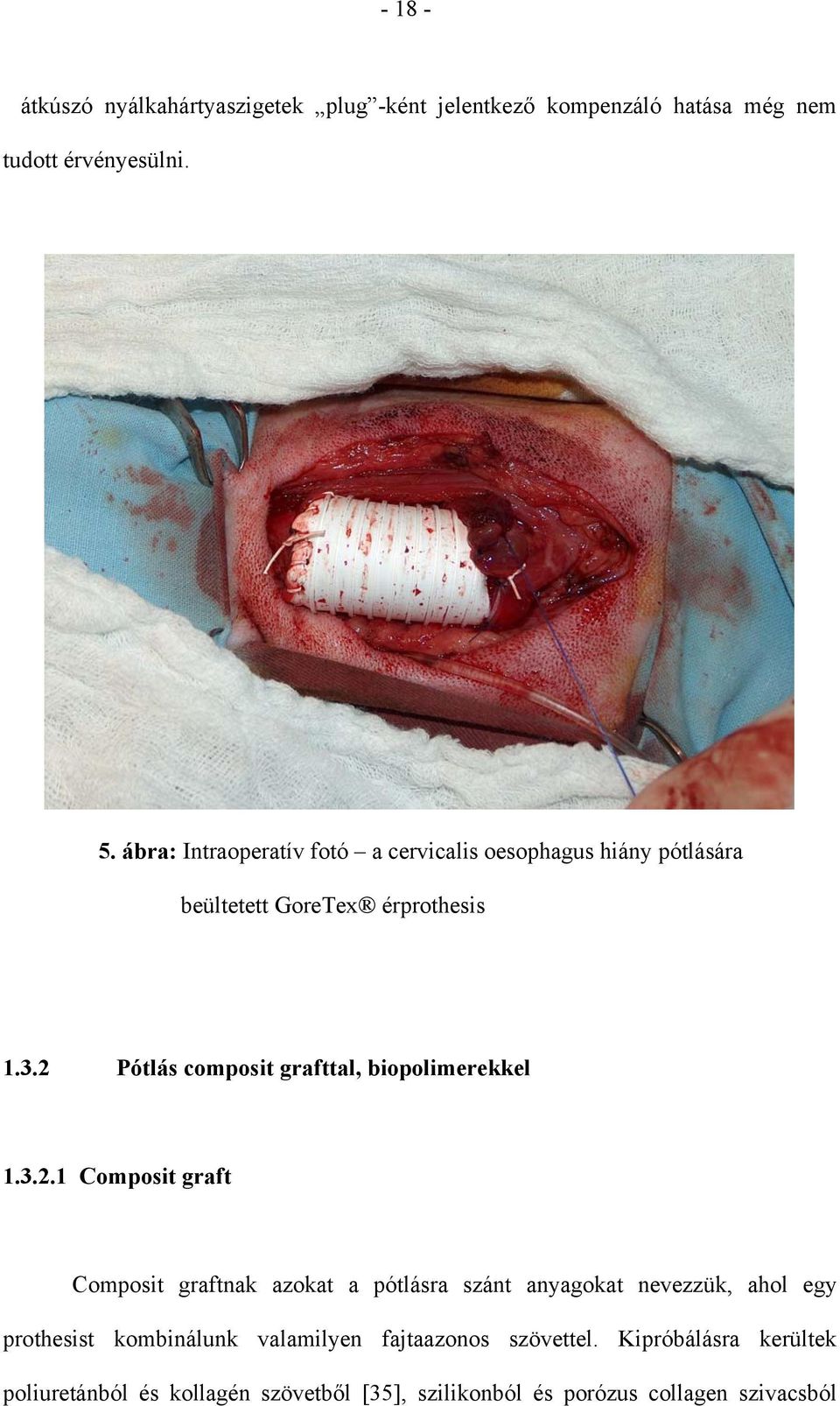 2 Pótlás composit grafttal, biopolimerekkel 1.3.2.1 Composit graft Composit graftnak azokat a pótlásra szánt anyagokat
