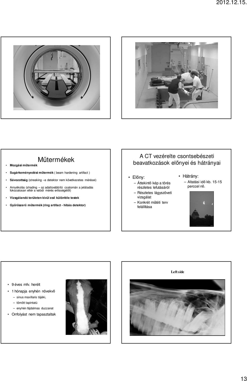 Győrőszerő mőtermék (ring artifact - hibás detektor) Elıny: Áttekintı kép a törés részletes lefutásáról Részletes lágyszöveti vizsgálat Konkrét mőtéti terv felállítása Hátrány: