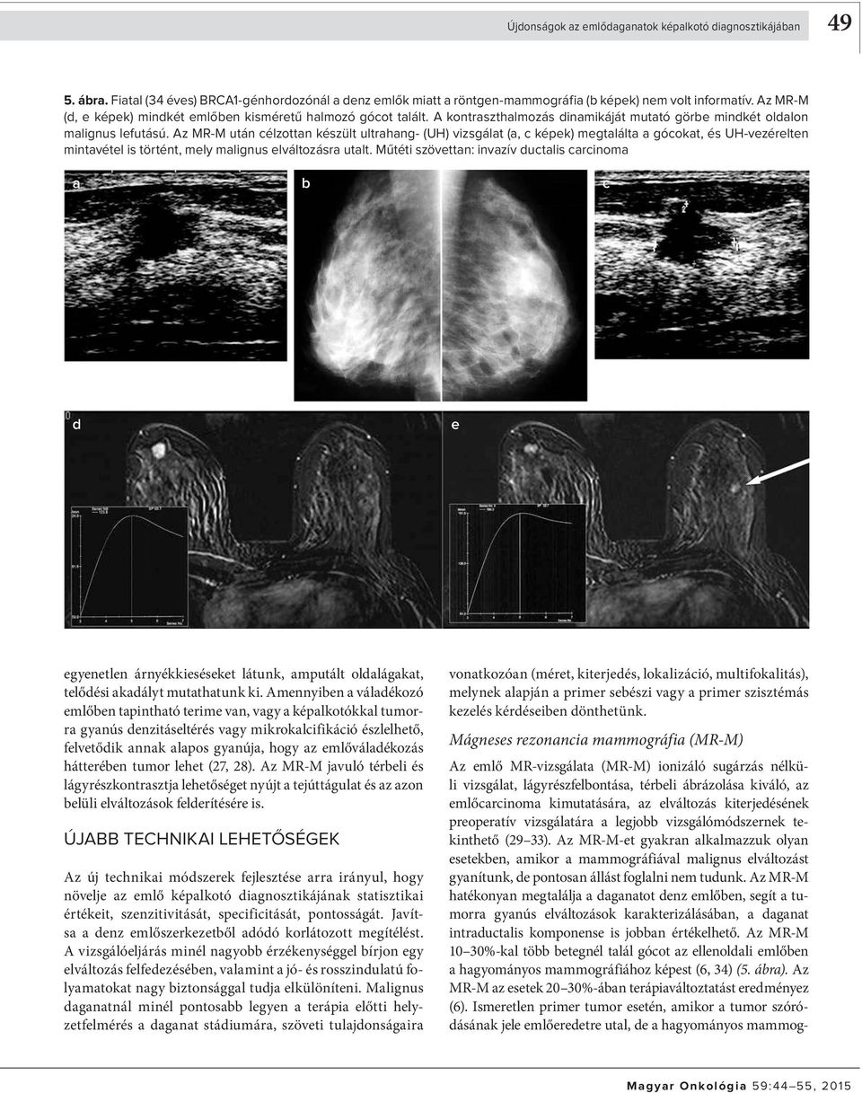 Az MR-M után célzottn készült ultrhng- (UH) vizsgált (, c képek) megtlált gócokt, és UH-vezérelten mintvétel is történt, mely mlignus elváltozásr utlt.