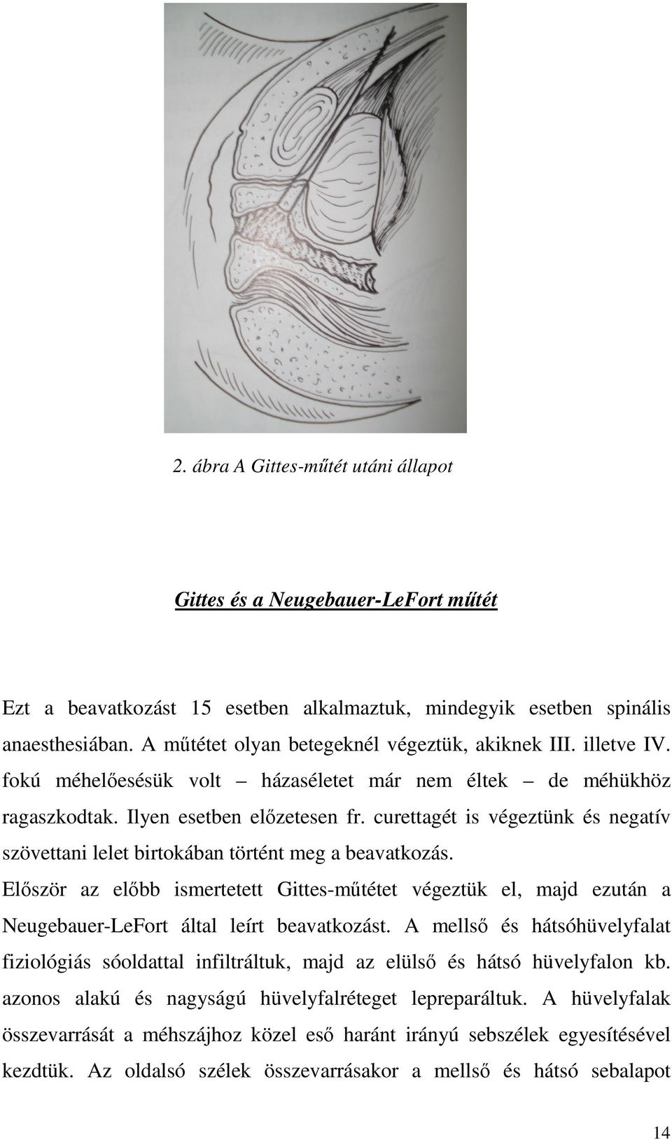 curettagét is végeztünk és negatív szövettani lelet birtokában történt meg a beavatkozás.