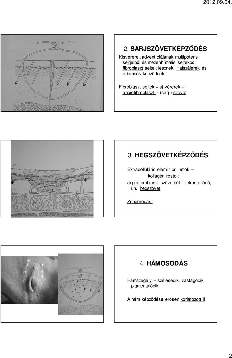 HEGSZÖVETKÉPZŐDÉS Extracelluláris elemi fibrillumok kollagén rostok angiofibroblaszt szövetből felrostozódó, un.