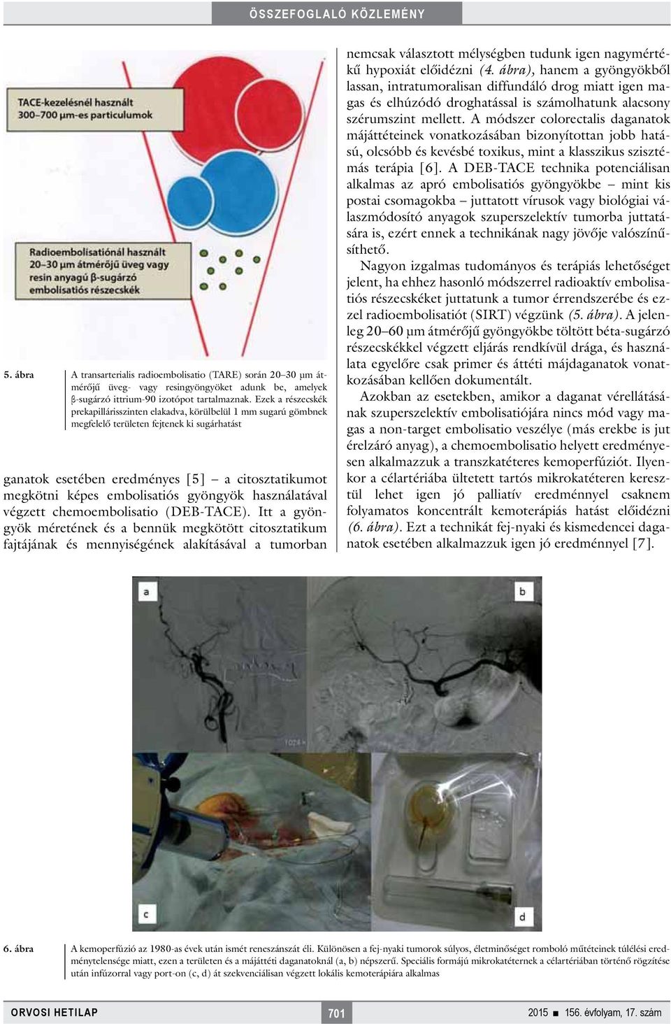 embolisatiós gyöngyök használatával végzett chemoembolisatio (DEB-TACE).