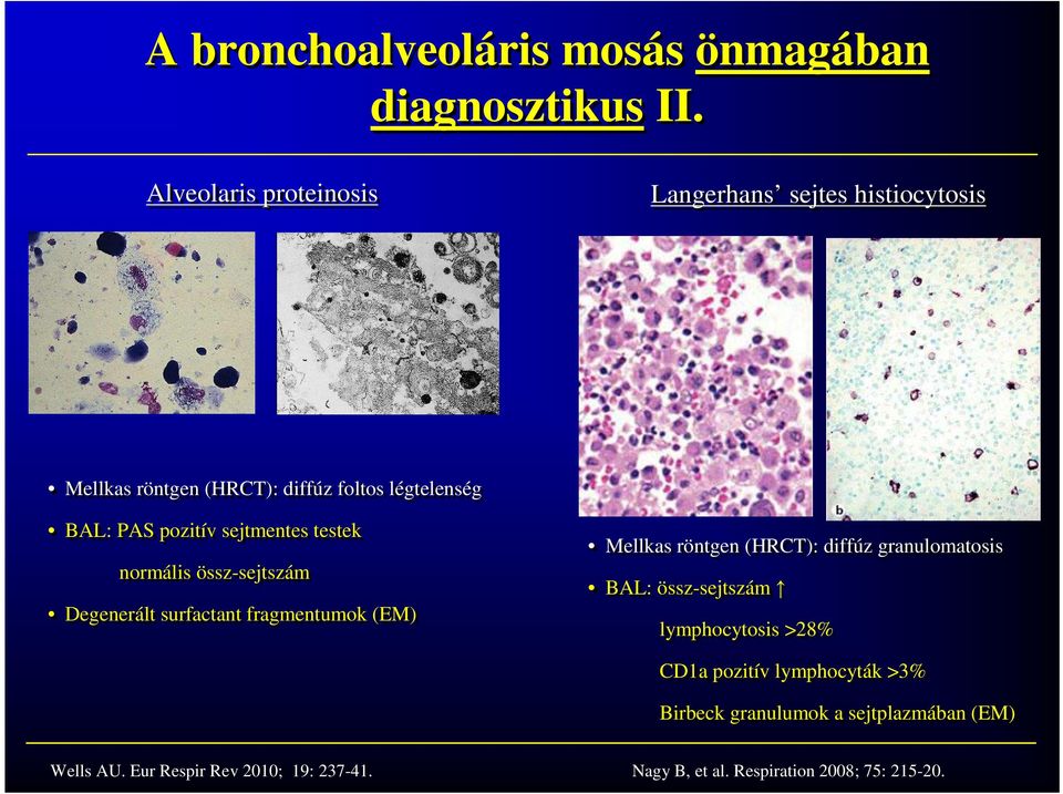 sejtmentes testek normális össz-sejtszám Degenerált surfactant fragmentumok (EM) Mellkas röntgen (HRCT): diffúz