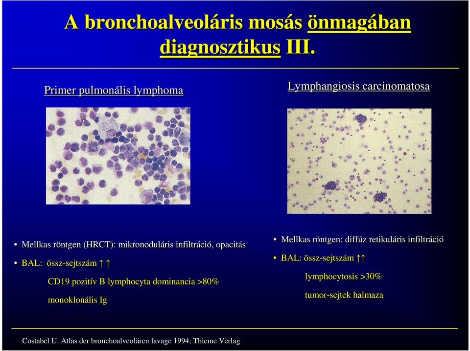 BAL: össz-sejtszám össz-sejtszám CD19 CD19 pozitív pozitív B B lymphocyta lymphocyta dominancia dominancia >80% >80% monoklonális monoklonális Ig Ig Costabel U.