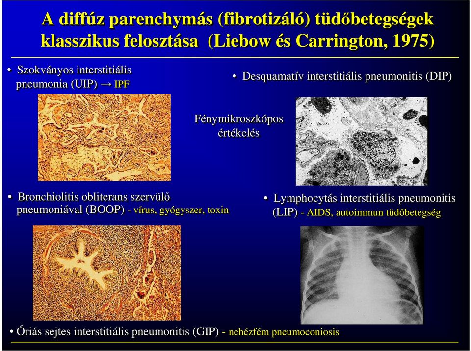 obliterans szervülı pneumoniával (BOOP) - vírus, gyógyszer, gyszer, toxin Lymphocytás s interstitiális pneumonitis (LIP) - AIDS,