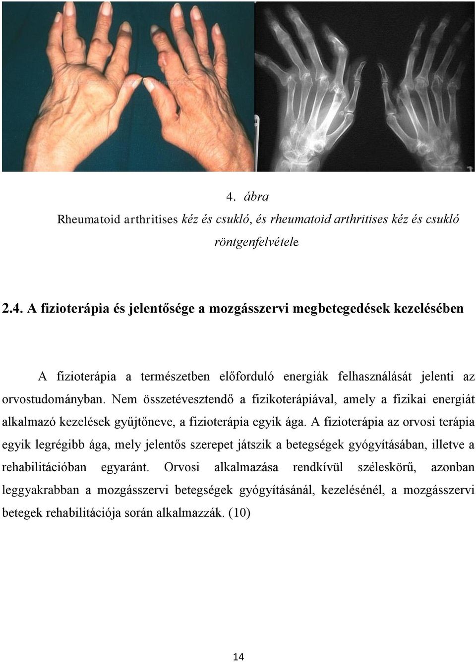 fizioterápia a kéz arthrosisának kezelésében)