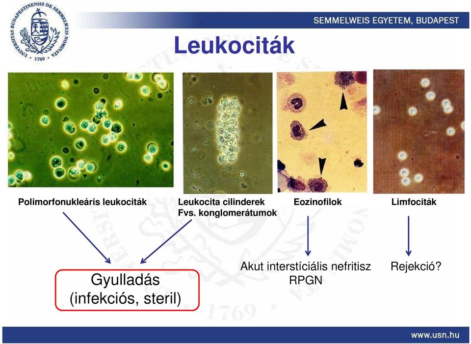 konglomerátumok Eozinofilok Limfociták