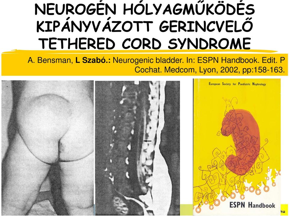 Bensman, L Szabó.: Neurogenic bladder.