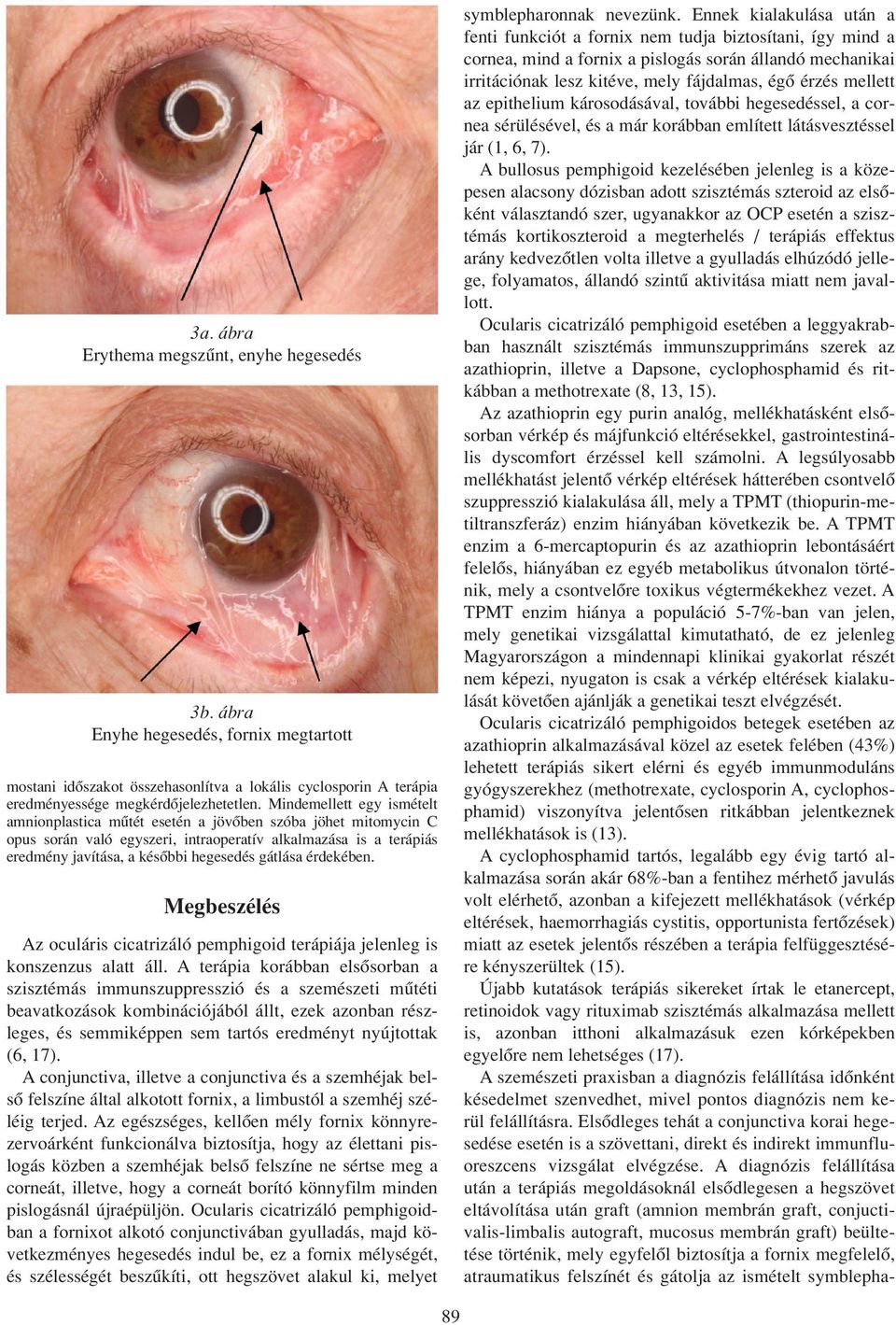 Oculáris cicatrizáló pemphigoid addicionális lokális immunszupprimáns  kezelése - PDF Ingyenes letöltés