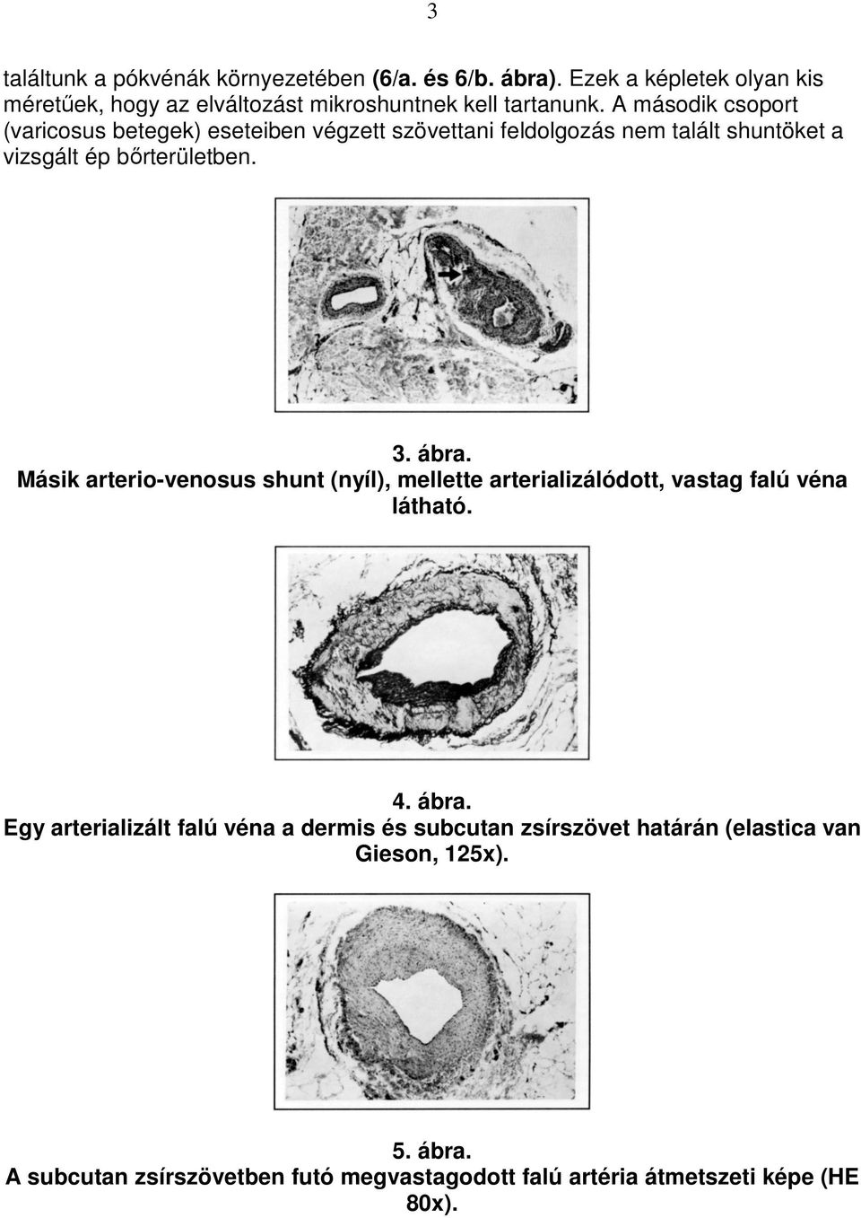 Másik arterio-venosus shunt (nyíl), mellette arterializálódott, vastag falú véna látható. 4. ábra.