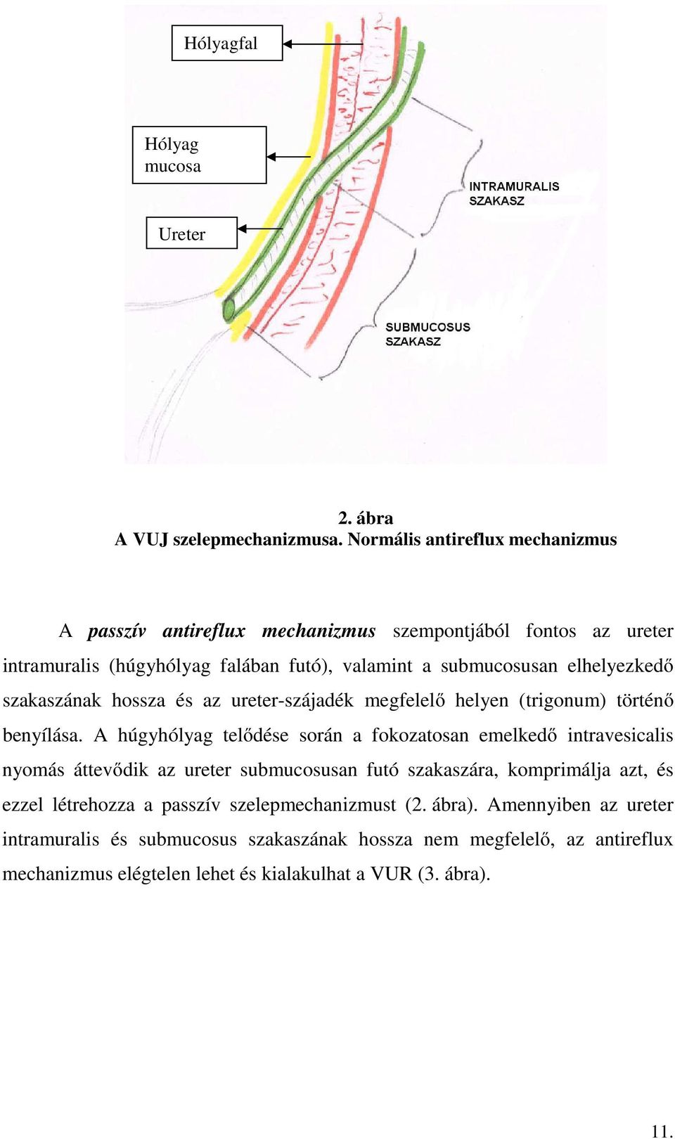 elhelyezkedő szakaszának hossza és az ureter-szájadék megfelelő helyen (trigonum) történő benyílása.