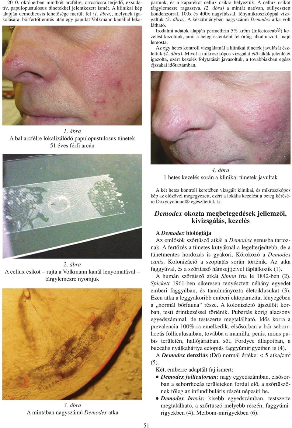 Demonstration of Demodex species in papulopustular rosacea I. Clinical  symptoms and diagnostic methods - PDF Free Download