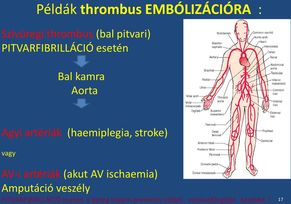 stroke) vagy AV-i artériák (akut AV ischaemia) Amputáció veszély