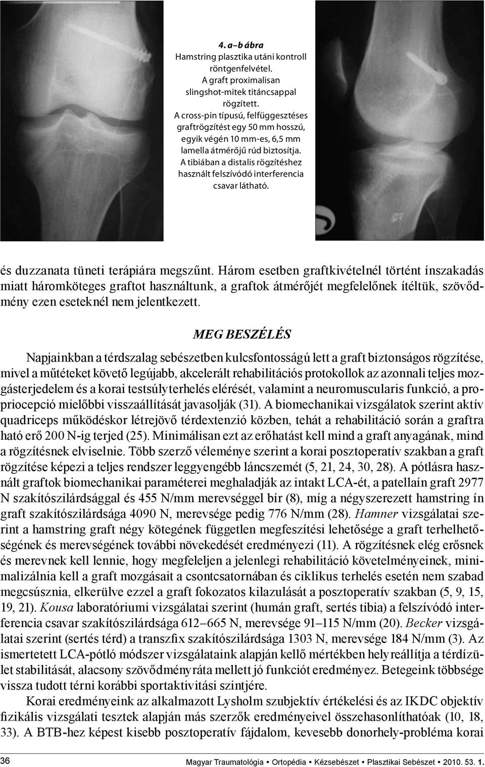 A tibiában a distalis rögzítéshez használt felszívódó interferencia csavar látható. és duzzanata tüneti terápiára megszűnt.