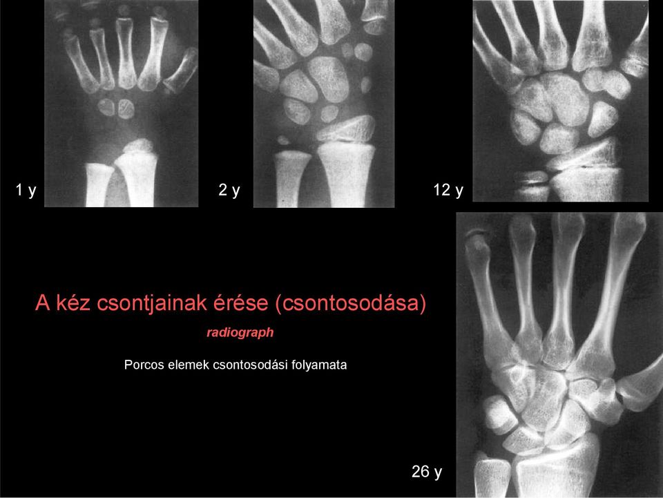 (csontosodása) radiograph