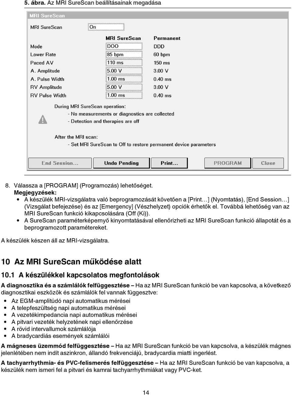 Továbbá lehetőség van az MRI SureScan funkció kikapcsolására (Off (Ki)). A SureScan paraméterképernyő kinyomtatásával ellenőrizheti az MRI SureScan funkció állapotát és a beprogramozott paramétereket.