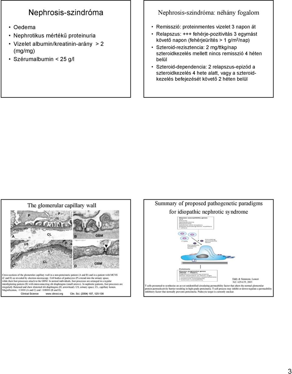 Szteroid-dependencia: 2 relapszus-epizód a szteroidkezelés 4 hete alatt, vagy a szteroidkezelés befejezését követő 2 héten belül The glomerular capillary wall Summary of proposed pathogenetic