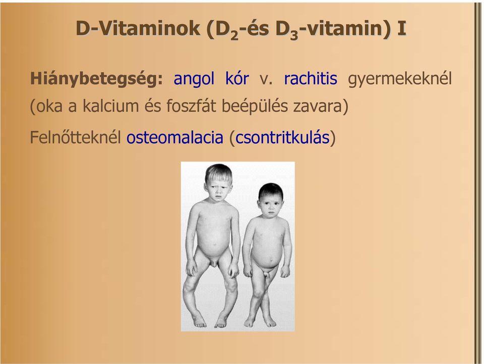 rachitis gyermekeknél (oka a kalcium és