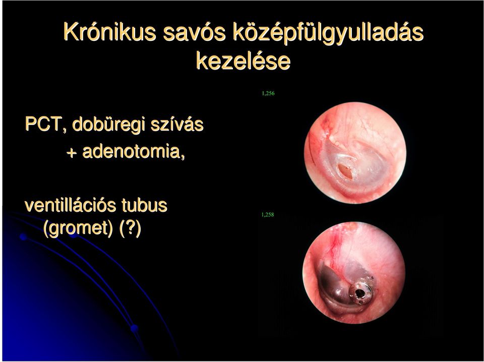 dobüregi szívás + adenotomia,