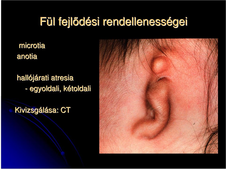 anotia hallójárati atresia -