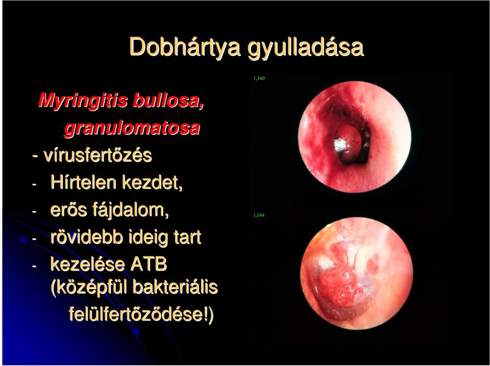 rövidebb ideig tart - kezelése ATB (középf pfül l