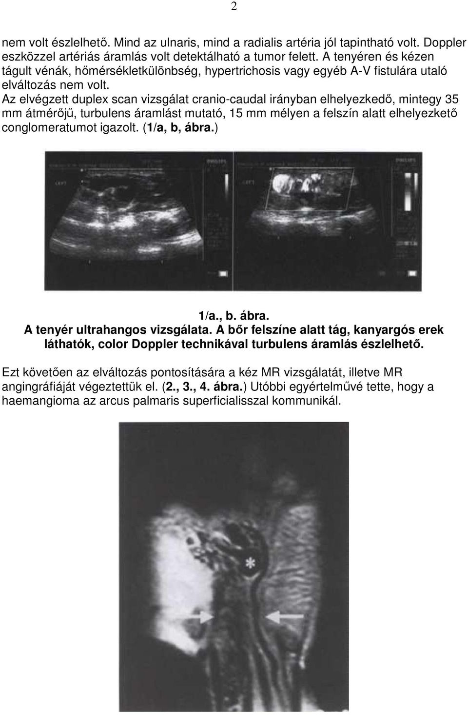 Az elvégzett duplex scan vizsgálat cranio-caudal irányban elhelyezkedı, mintegy 35 mm átmérıjő, turbulens áramlást mutató, 15 mm mélyen a felszín alatt elhelyezketı conglomeratumot igazolt.