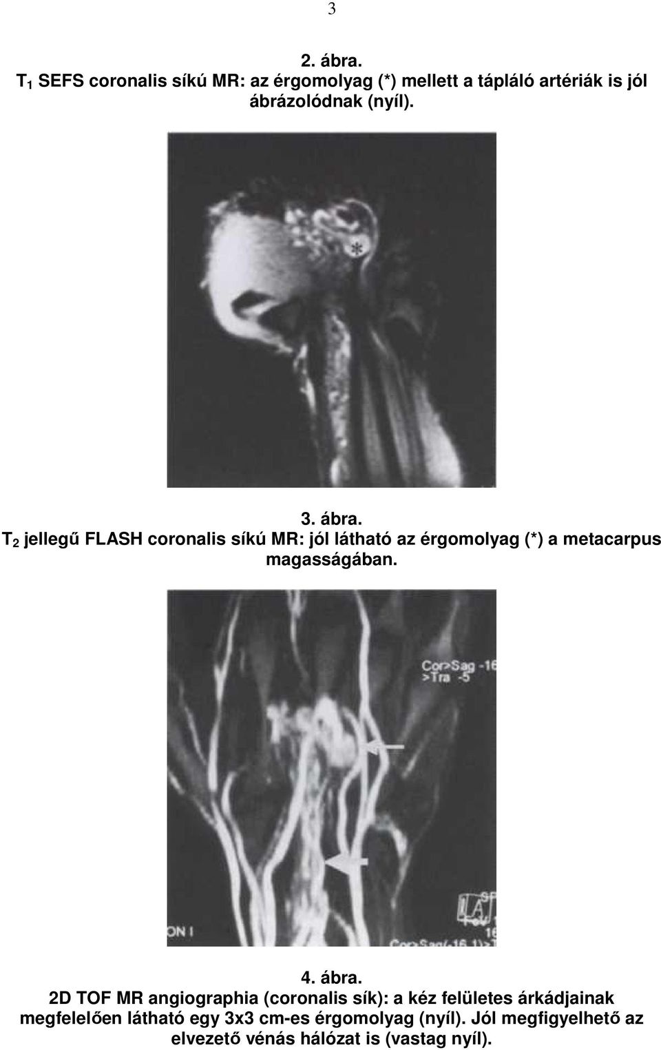 3. ábra. T 2 jellegő FLASH coronalis síkú MR: jól látható az érgomolyag (*) a metacarpus magasságában.