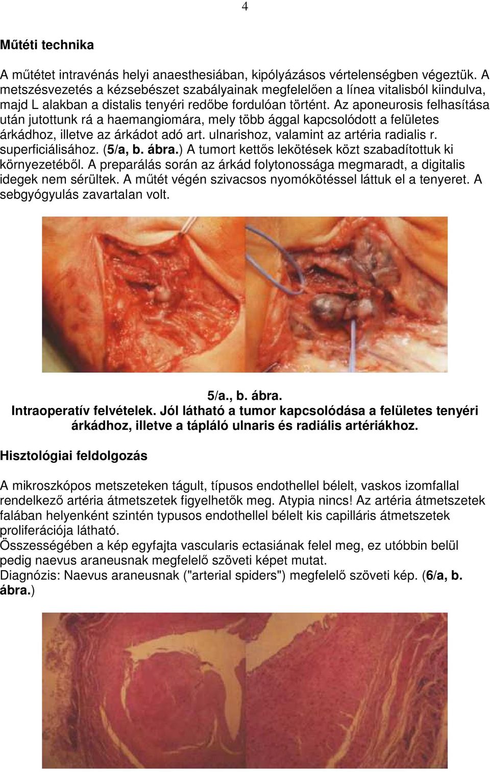 Az aponeurosis felhasítása után jutottunk rá a haemangiomára, mely több ággal kapcsolódott a felületes árkádhoz, illetve az árkádot adó art. ulnarishoz, valamint az artéria radialis r.
