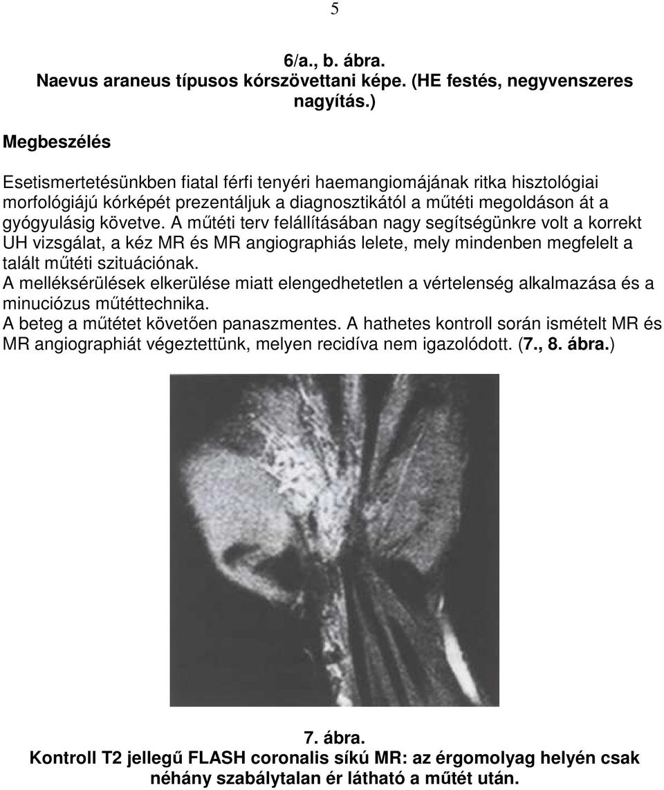 A mőtéti terv felállításában nagy segítségünkre volt a korrekt UH vizsgálat, a kéz MR és MR angiographiás lelete, mely mindenben megfelelt a talált mőtéti szituációnak.