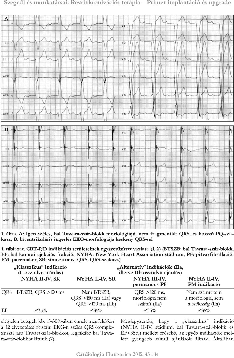 pacemaker, SR: sinusritmus, QRS: QRS-szakasz) Klasszikus indikáció (I.