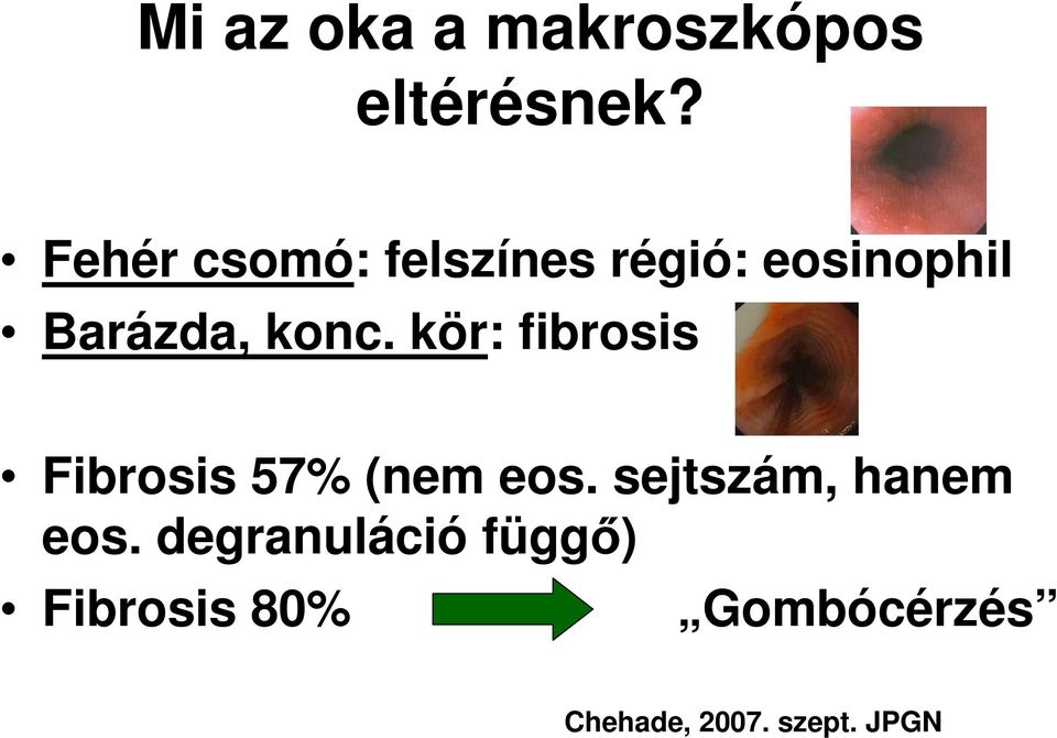 kör: fibrosis Fibrosis 57% (nem eos.