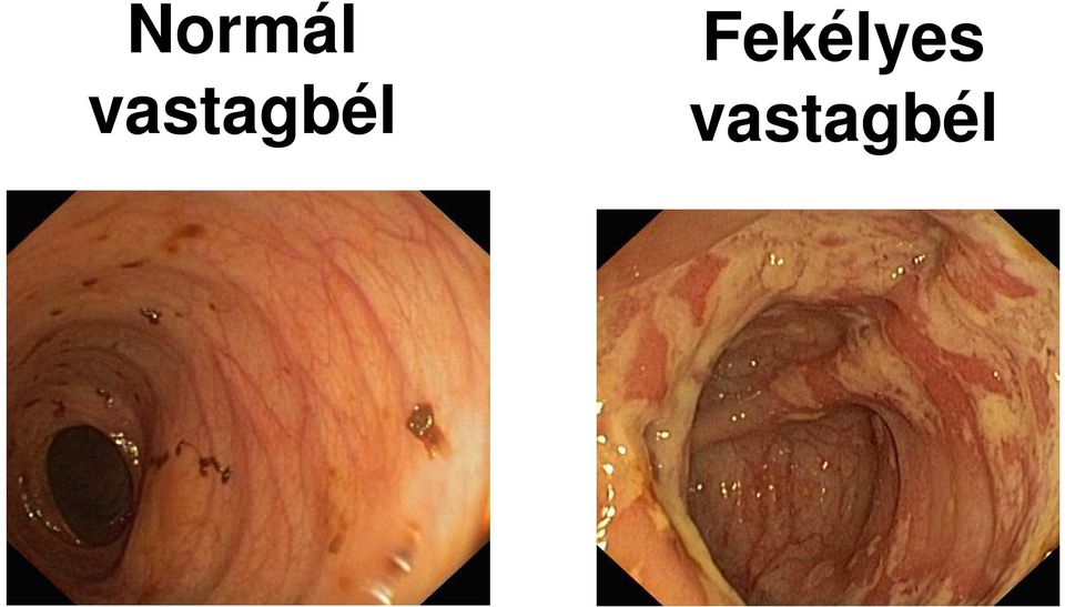 Fekélyes