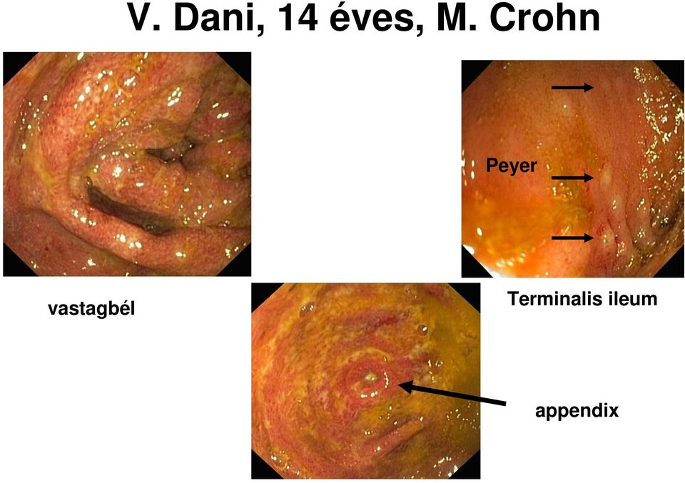 Crohn Peyer