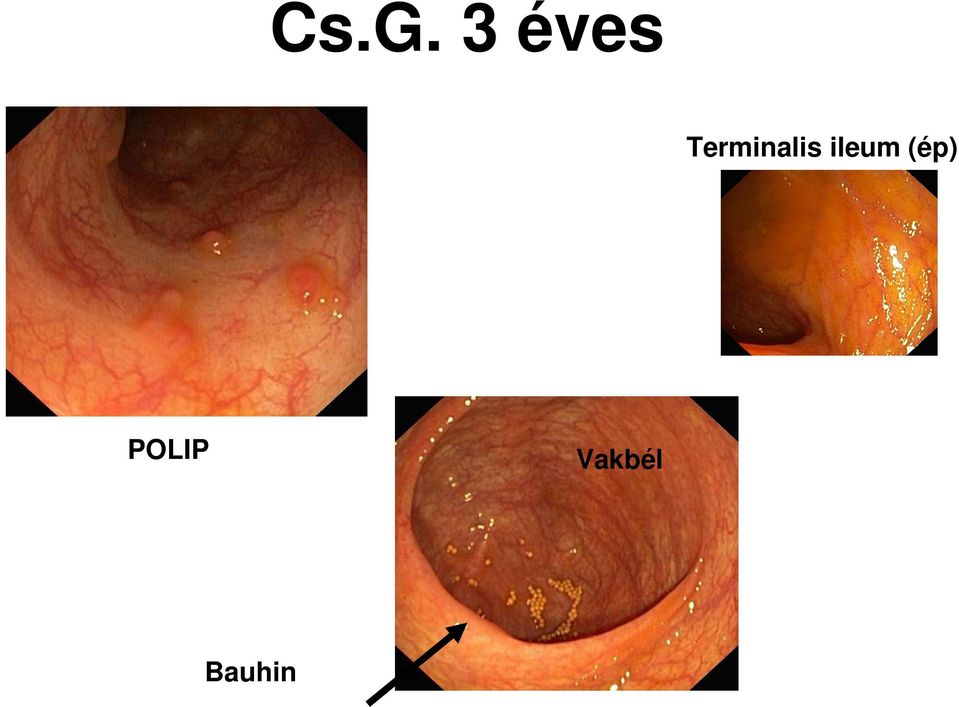 ileum (ép)