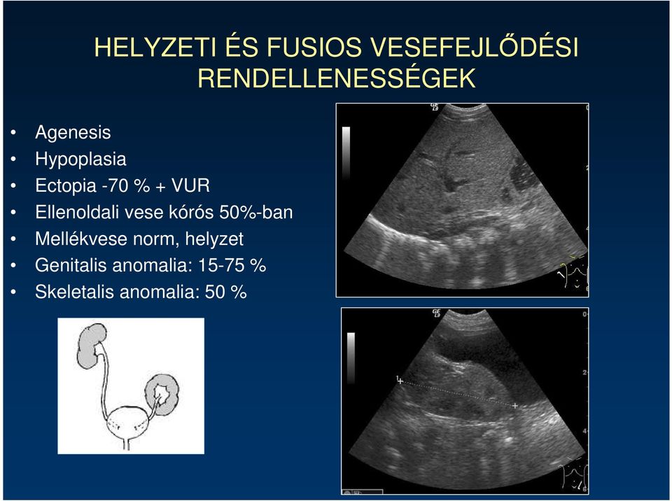 Ellenoldali vese kórós 50%-ban Mellékvese norm,