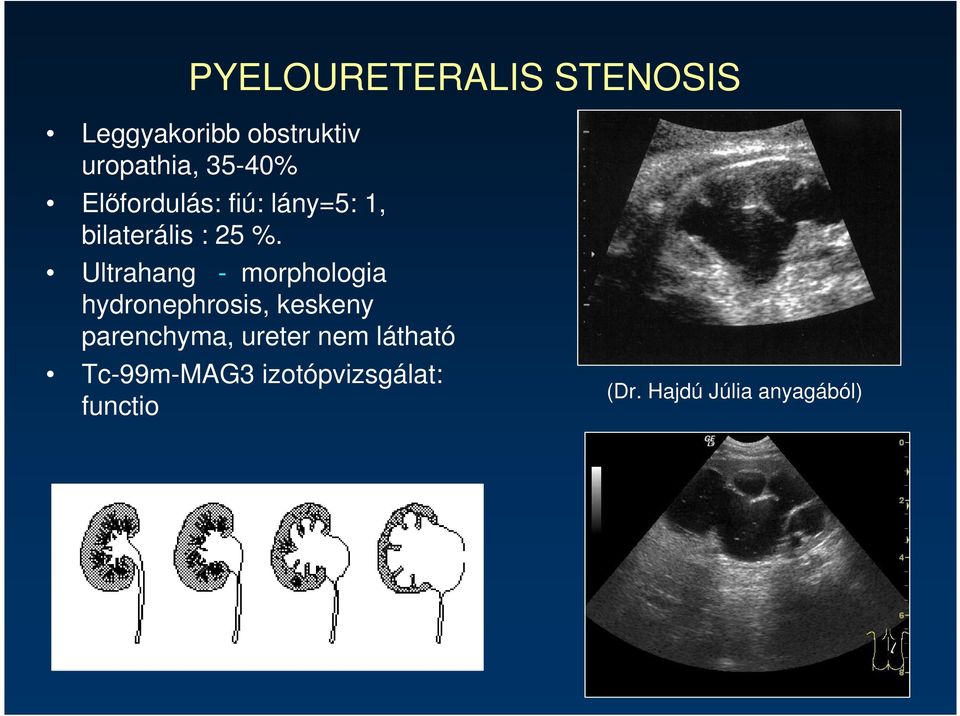 Ultrahang - morphologia hydronephrosis, keskeny parenchyma,