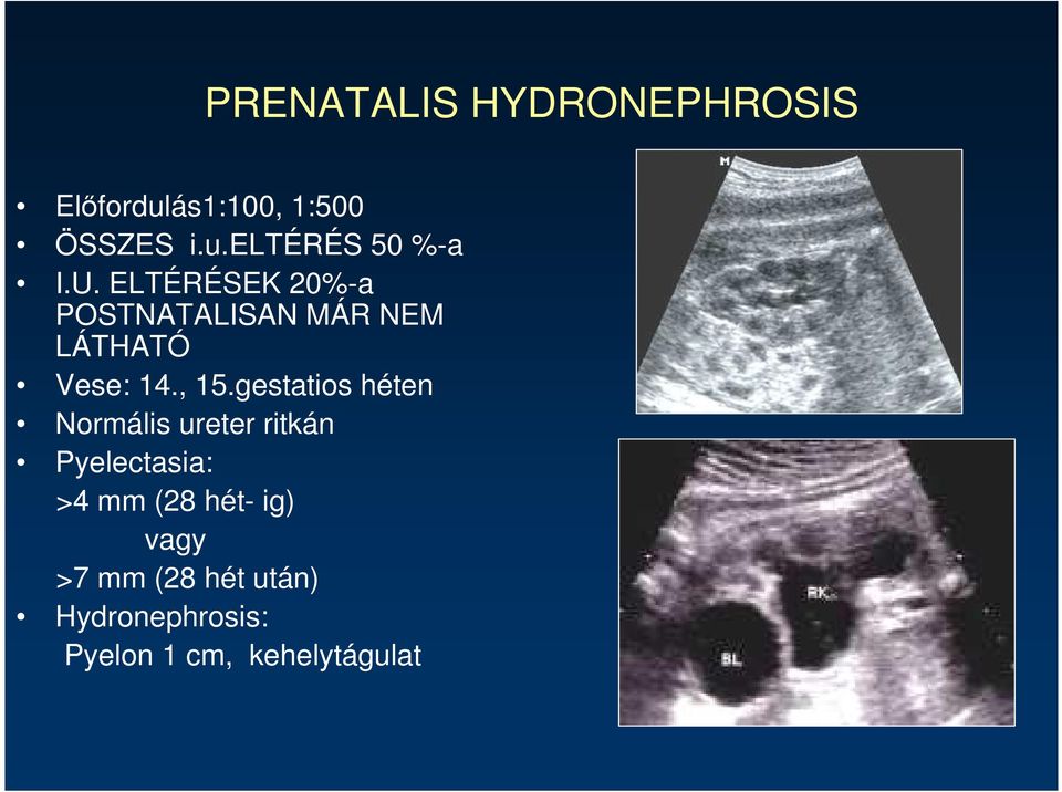 gestatios héten Normális ureter ritkán Pyelectasia: >4 mm (28 hét-