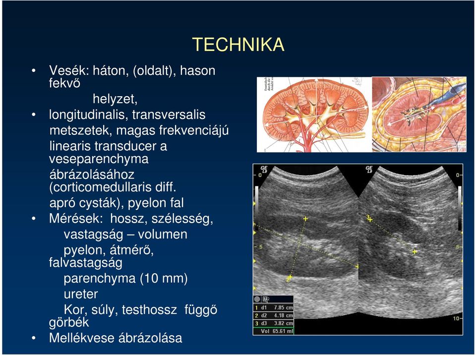 apró cysták), pyelon fal Mérések: hossz, szélesség, vastagság volumen pyelon, átmérı,