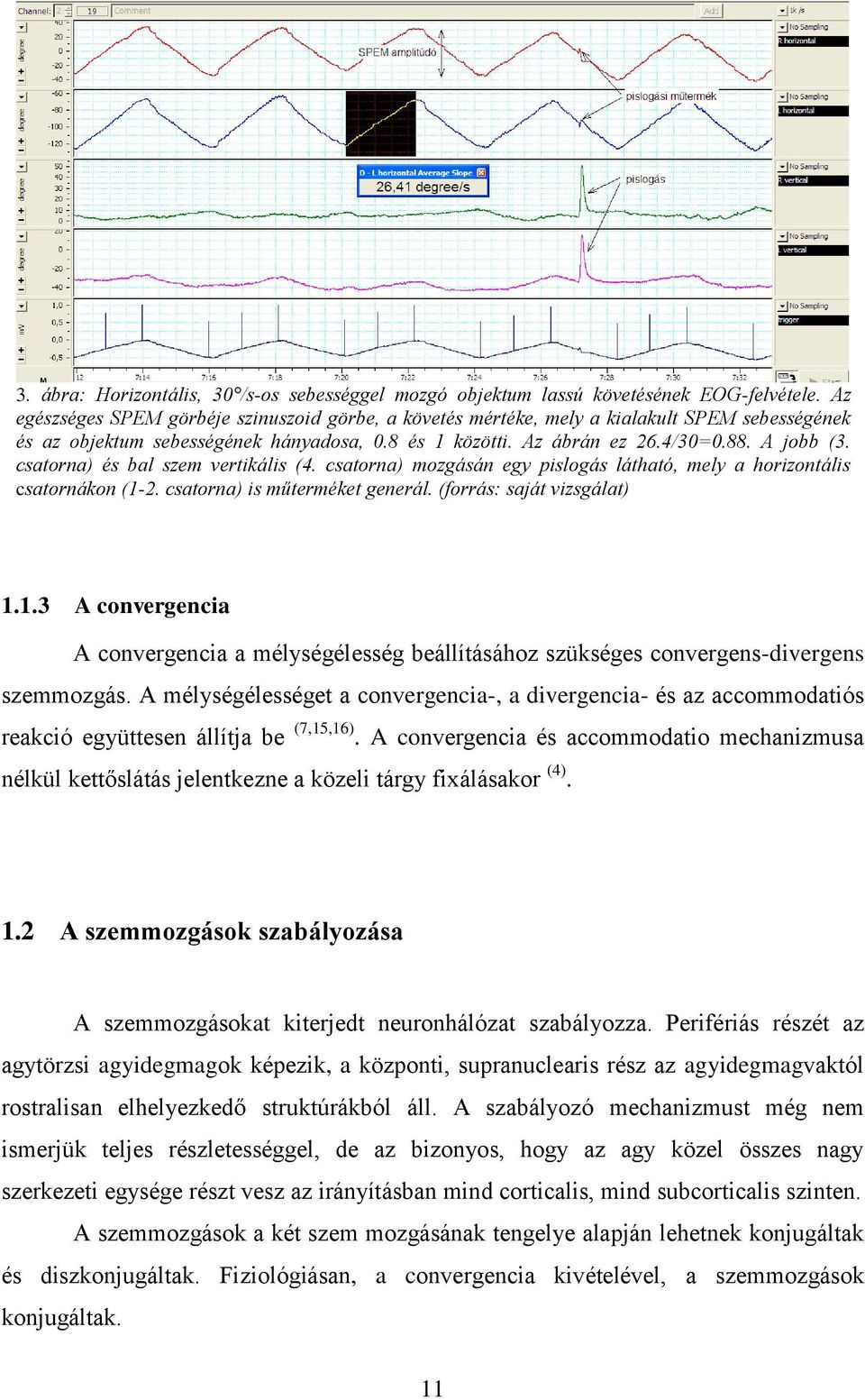 csatorna) és bal szem vertikális (4. csatorna) mozgásán egy pislogás látható, mely a horizontális csatornákon (1-