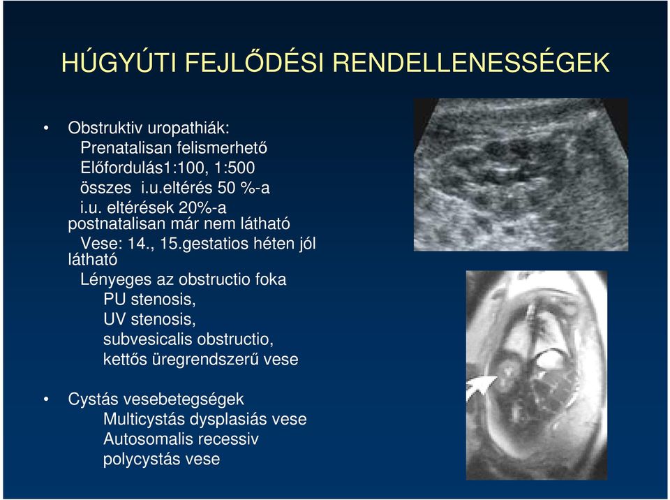 gestatios héten jól látható Lényeges az obstructio foka PU stenosis, UV stenosis, subvesicalis