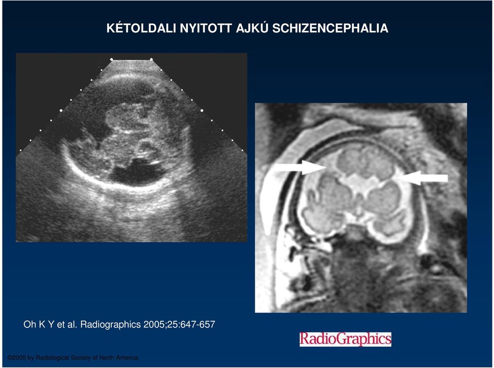 Radiographics 2005;25:647-657