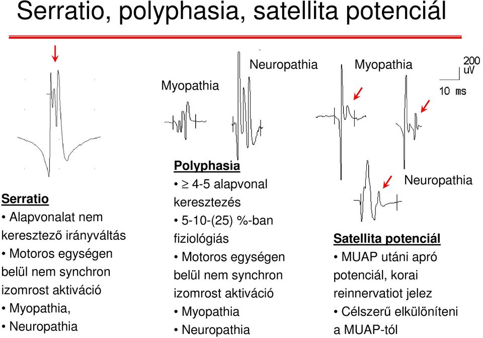 keresztezés 5-10-(25) %-ban fiziológiás Motoros egységen belül nem synchron izomrost aktiváció Myopathia