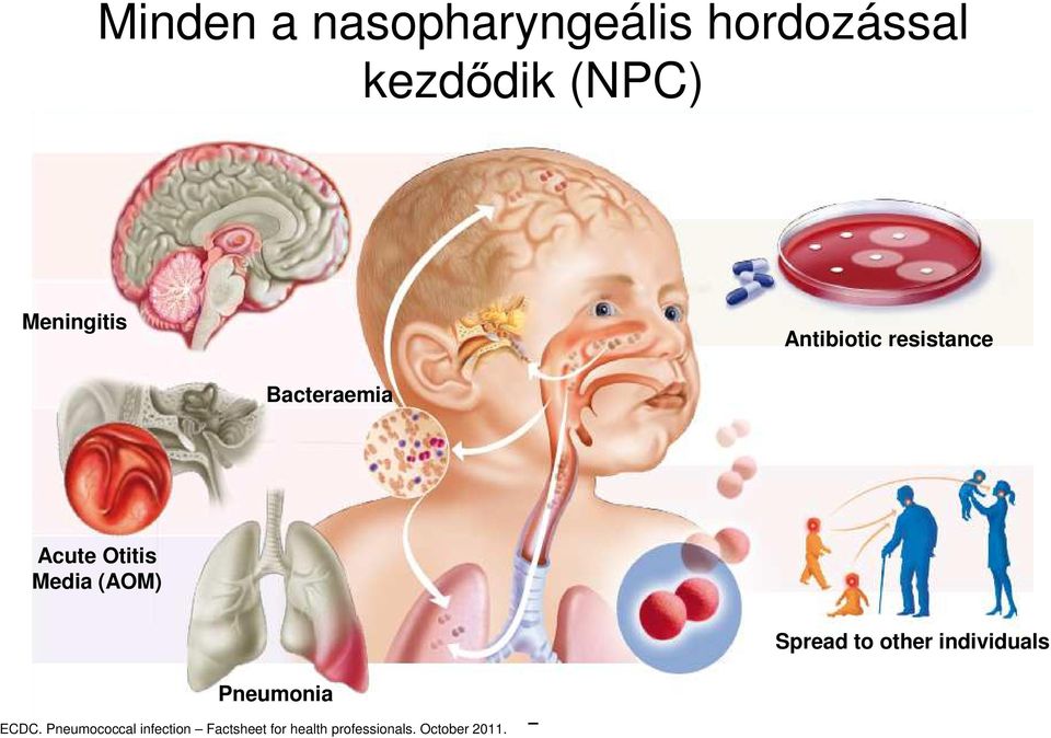 Media (AOM) Spread to other individuals Pneumonia ECDC.
