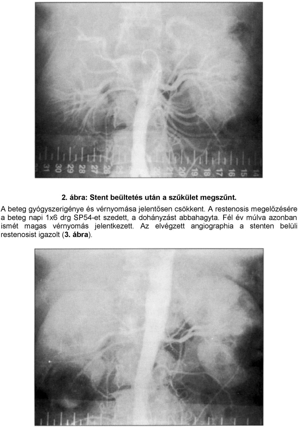 A restenosis megelőzésére a beteg napi 1x6 drg SP54-et szedett, a dohányzást