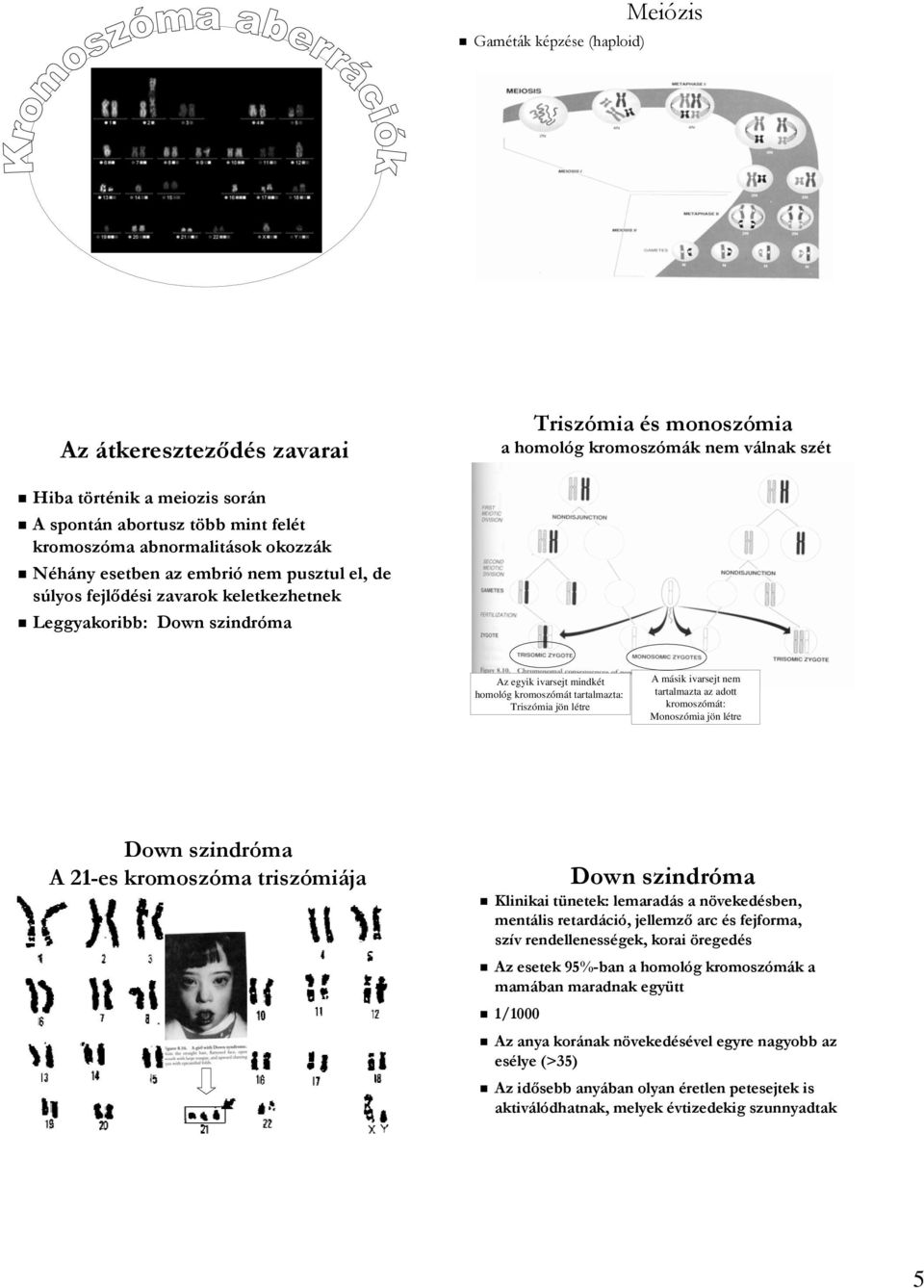 Triszómia jön létre A másik ivarsejt nem tartalmazta az adott kromoszómát: Monoszómia jön létre Down szindróma A 21-es kromoszóma triszómiája Down szindróma Klinikai tünetek: lemaradás a