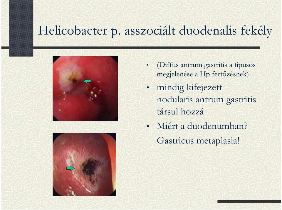 gastritis a típusos megjelenése a Hp fertızésnek)