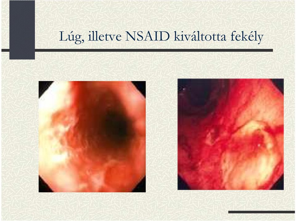 NSAID