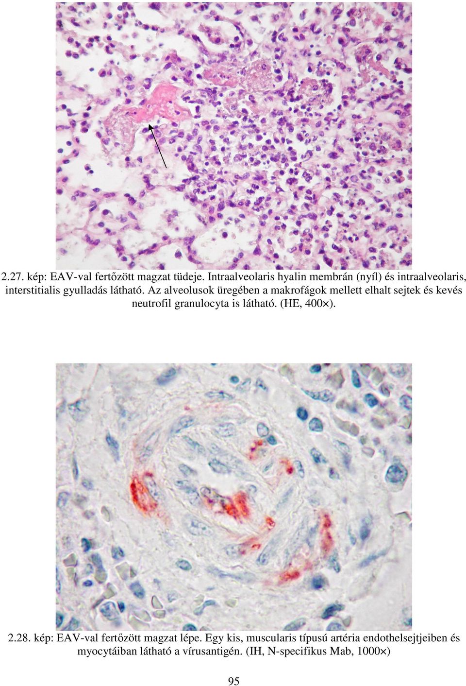 Az alveolusok üregében a makrofágok mellett elhalt sejtek és kevés neutrofil granulocyta is látható.
